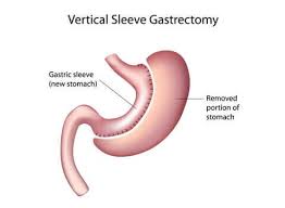 gastric sleeve vs gastric byp all
