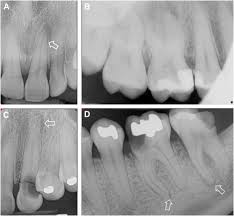 Image result for Periapical Block