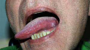 Let your doctor know about any changes or problems you notice, because they could be caused by the cancer coming back or by a new disease or second cancer. Tongue Cancer Symptoms Pictures Prognosis