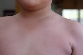 Wie lange ist scharlach ansteckend? Scharlach Ursachen Symptome Und Therapie Rundumgesund De