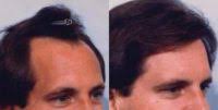 Dr toby mayer revision rhinoplasty. Doctor Toby Mayer Md Facial Plastic Surgeon Eyelid Surgery Cost Photos Rewiews Q A