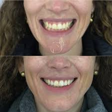 O botox é uma das formas mais eficazes e seguras de corrigir o sorriso  gengival, aquele em que parte da gengiva fica excessivamente exposta ao  sorrir. Isso acontece porque alguns músculos da