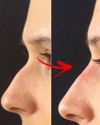 See before and after photos of our nose job (rhinoplast)y treatment from our london clinic. Non Surgical Nose Job V Rhinoplasty Before After Transformation Pictures Revealed Express Co Uk