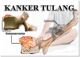 Image result for kanker