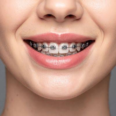 Metal Braces product image