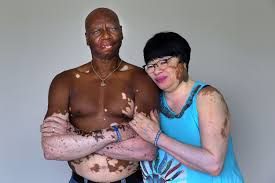 Image result for Vitiligo