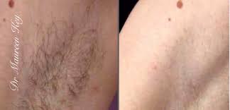 Laser hair removal colorado springs a new image laser and skin care clinic 5145 n. Laser Hair Removal Permanent Hair Removal New Look Solutions