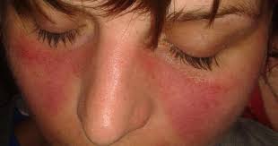 Maybe you would like to learn more about one of these? Lupus Erythematodes Med Kom