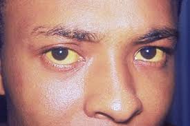 Mungkin saat awal terserang flu, maka ingus akan berwarna bening dan tidak terlalu kental (cair). Penyakit Kuning Gejala Penyebab Obat Dan Pencegahan