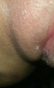 Unlike genital herpes, ingrown hairs typically develop as isolated lesions or bumps. Strange Line Of Bumps On Vagina Genital Warts Ingrown Hairs Scared And Confused Help Std