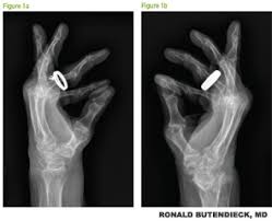 Image result for XRay Changes in Rheumatic Conditions