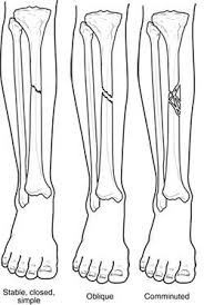In case a common area does this way the backbone receives all the aggregate addresses and in turn will injects them, already summarized, into other areas. Fractures Broken Bones Orthoinfo Aaos
