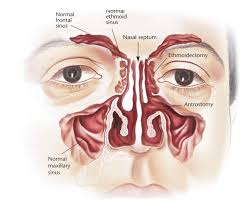Nasal polyp removal (nasal polypectomy) is a surgical procedure that aims to remove your nasal polyps. Sinus Surgery Dr Bridget Clancy Ent Surgeon