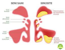 Sinusite Nei Bambini Diagnosi E Trattamento