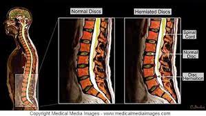 Color Mri Of The Lumbar Spine Low Back Showing A Normal Lumbar Spine And One With Disc Herniations Created By Medical Media Imag Disk Herniation Mri Anatomy