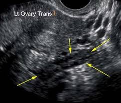 Ways to find ovarian cancer early. Normal Ovary Ultrasound How To