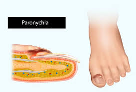 Image result for Paronychia feet