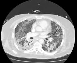Image result for Cor Pulmonale