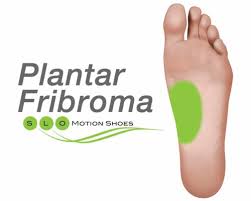Pain in the arch of the foot can be caused by various conditions. Plantar Fibroma Slo Motion Shoesslo Motion Shoes