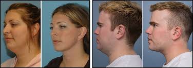 So, how exactly do you get rid of face fat for good? 12 Ways To Get Rid Of A Double Chin Fast Without Surgery