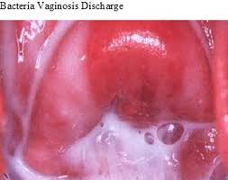 Bacterial vaginosis and hiv acquisition: Facebook