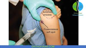 Image result for Subacromial Space Injection