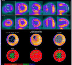 What is a nuclear heart test. 82 Rb Cardiac Pet Pharmacological Stress Test Adenosine And Rest Download Scientific Diagram
