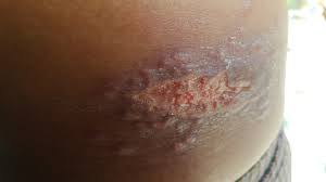 Makan kena pantang seperti orang dalam pantang. Kayap Singles Herpes Zoster Laskarayaqbiru