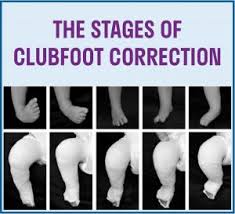 Clubfoot is one of the most common congenital birth defects. Treatment Strategies Paley Orthopedic Spine Institute