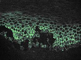 Pemphigus foliaceus is a rare autoimmune blistering disease which is characterised by superficial blisters, erosions and crusts on the skin. Pemphigus Wikipedia