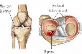 Meniscul este o structură fibrocartilaginoasă semilunară întâlnită la ambii genunchi la periferia foselor articulare tibiale. Totul Despre Ruptura De Menisc Cauze Simptome Si Tratament