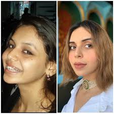 Will my nose look bigger if I lose weight?