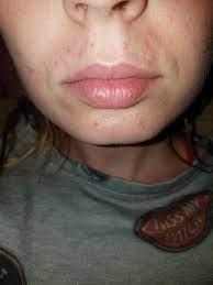 Skin Concerns Waxed Upper Lip 2 Days Later These Show Up Anything I Can Do Vacation Next Week Skincareaddiction