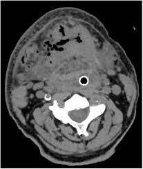 Image result for phlegmon on face)