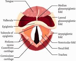 Image result for Epiglottitis