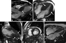 Image result for Cardiac MRI