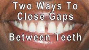Jun 29, 2021 · occasionally it's possible to use veneers to fix missing teeth, but only if there is a very small gap left between two teeth. How To Get Rid Of Gaps In Teeth 14 Steps With Pictures