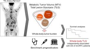 Metastatic prostate cancer most often spreads to the liver, bones and lungs. Quantification Of Metastatic Prostate Cancer Whole Body Tumor Burden With 18f Fdg Pet Parameters And Associations With Overall Survival After First Line Abiraterone Or Enzalutamide A Single Center Retrospective Cohort Study Journal Of Nuclear Medicine