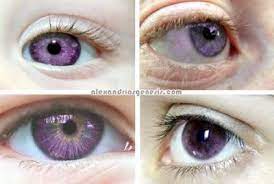 What Is Alexandria S Genesis Healthmad Com Purple Eyes Disease Purple Eyes Rare Eye Colors