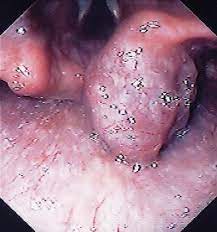 Blue Rubber Bleb Nevus Syndrome Causing Upper Gi Hemorrhage A Novel Management Approach And Review Gastrointestinal Endoscopy