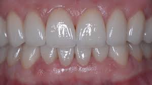 Process of Installation of Ceramic Veneers in Dubai And Their Lifespan