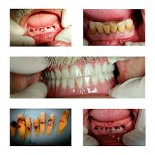Check spelling or type a new query. Immediate Dentures Before And After Dental Cases Smile Gallery Dentist In Simi Valley Dental Dentist In Dental Veneers