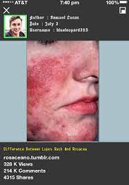 Difference Between Lupus Rash And Rosacea 105344 Rosacea Free Forever Ocular Rosacea Rosacea Skin Care Rosacea Causes