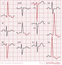 Image result for Left Ventricular Hypertrophy