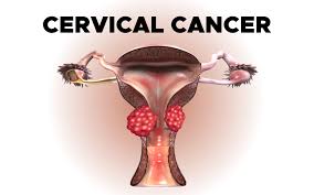 Image result for Cervical Cancer