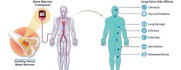 8 Linkedin Bone Marrow Medical Tourism Stem Cell Transplant