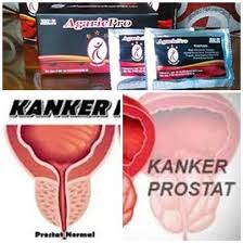 Kanker prostat adalah penyakit kanker yang berkembang di prostat, sebuah kelenjar dalam sistem reproduksi lelaki. Jual Cara Mengatasi Penyakit Kanker Prostat Di Lapak Evrida Herbal Bukalapak