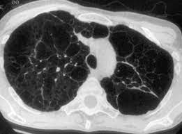 Lymphangioleiomyomatosis Radiologic Pathologic Correlation Radiographics