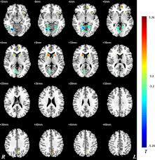 As a matter of fact, i took a lie detector test that made polygraph tests look more accurate than they might actually be because people who believe that the polygraph will work get very nervous before. Altered Spontaneous Brain Activity In Obsessive Compulsive Personality Disorder Sciencedirect