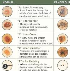 In the united states, it's estimated that doctors diagnose over 100,000 new skin cancer cases each year. Pin On My Pins